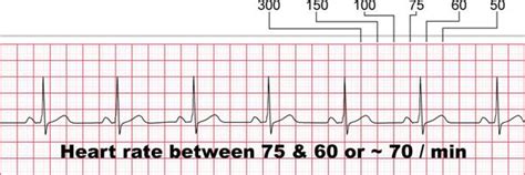 How To Work Out Heart Rate From Ecg Rating Walls