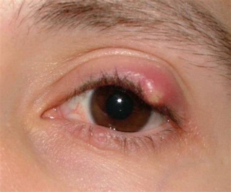 Chalazion Eyelid Cyst Causes Symptoms Treatment