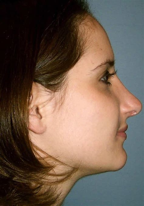 Rhinoplasty Cosmetic Nose Surgery Cleveland Cosmetic Surgery