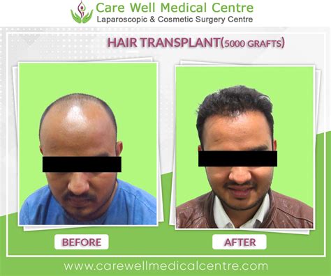 Hair Transplant Before And After Photos Care Well Medical Centre