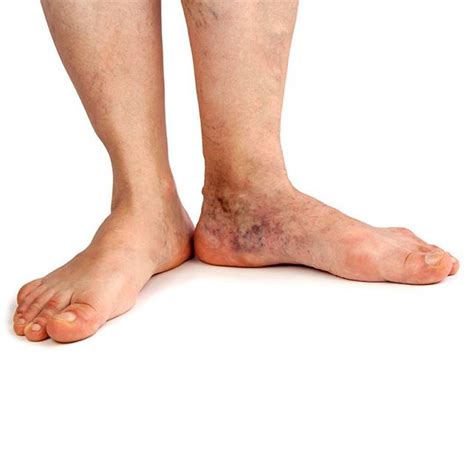 Patients with severe venous disease may have signs such as venous ...