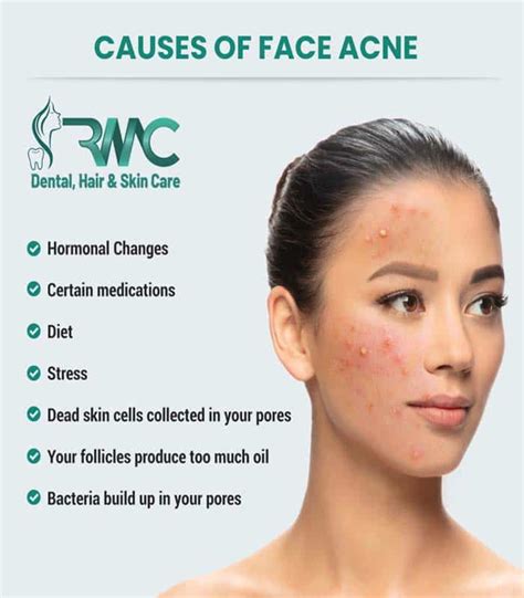 Acne Scars Types Causes And Treatment In Islamabad