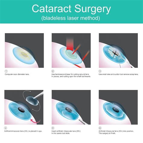 Guide To Cataract Surgery In Singapore 2021 By Dr Claudine Pang