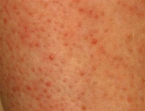 Blood Spots On Skin Red Tiny Raised Itchy Bumps Pictures Causes