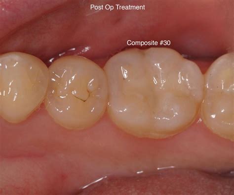 Composite Fillings Raritan Valley Dental