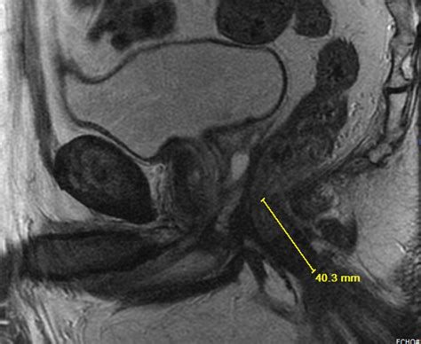 Mri Of Rectal Cancer Tumor Staging Imaging Techniques And Management Vrogue