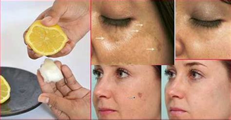 Remove Dark Spots And Acne Scars From Face