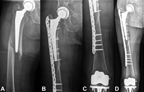 Treatment Of Periprosthetic Femoral Fractures Vancouver Type B