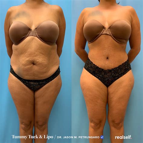 Tummy Tuck Surgery The Ultimate Guide To Abdominoplasty Tummy Tucks