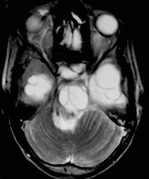 Ce3 Cyst Axial T2 Weighted Image Shows A Maternal Hydatid Cyst