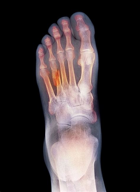 Fractured Foot X Ray Photograph By Du Cane Medical Imaging Ltd Fine