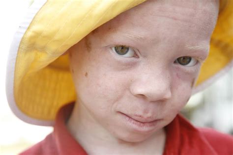 Albinism Pictures Symptoms And Pictures