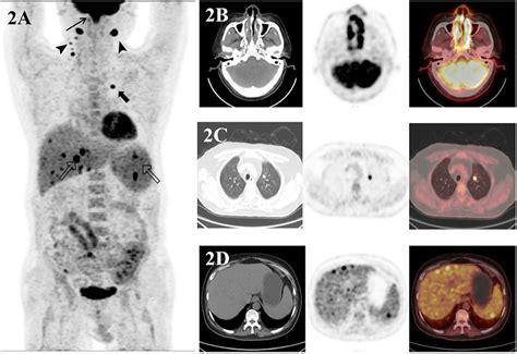 Petct Scans ‘crucial In Patients With Nkt Cell Lymphoma Auntminnie
