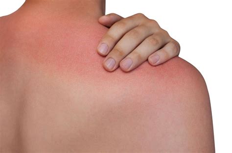Consejos Para Prevenir Y Tratar La Alergia Al Sol