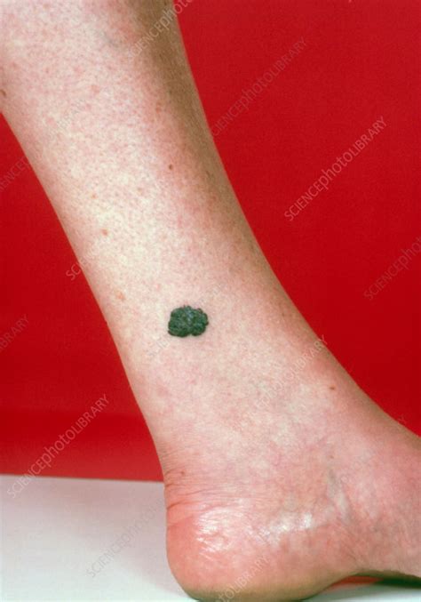 Malignant Melanoma On Lower Leg Stock Image M1310026 Science