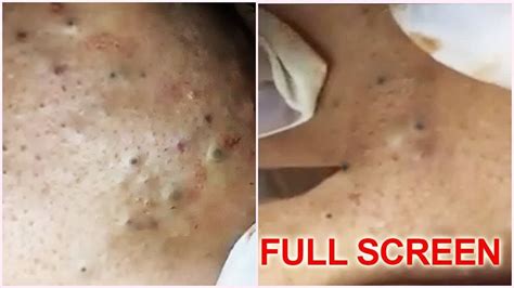 Acne Treatment Vlogs 5 Years Old Blackheads Removal Best Pimple