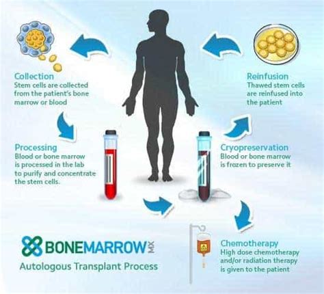 Autologous Stem Cell Transplantation Uams Stem Cell Transplantation