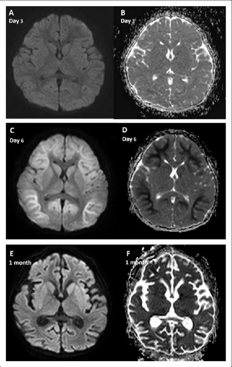 Initial Brain Magnetic Resonance Diffusion Weighted Images A And