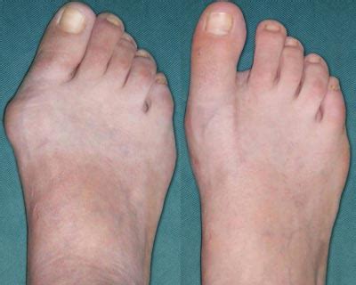 Dieser film zeigt explizit medizinische inhalte in aller deutlichkeit! Großzehenschiefstellung: Hallux valgus - orthomannheim.de