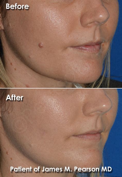 Mole Removal Photos Before After Dr James Pearson Facial Plastic