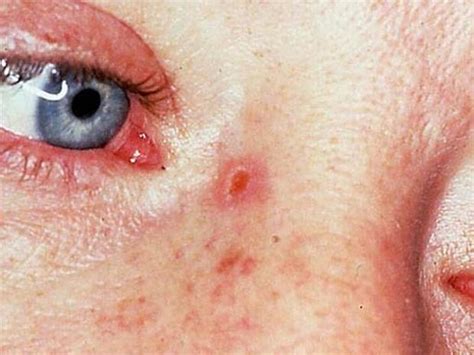 Basal Cell Carcinoma On The Nose Skin Cancer Or Mole How To Tell