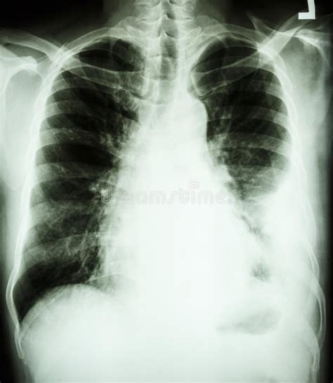 Chest Xray Of Lung Cancer In A Man Stock Photo More