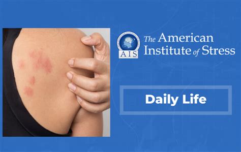 What To Do When Stress Gives You Hives The American Institute Of Stress