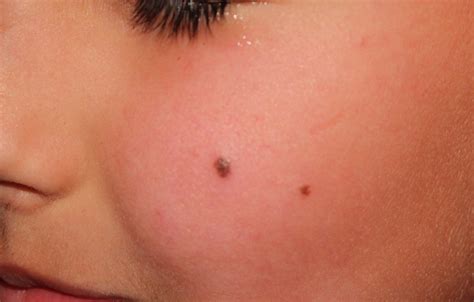 17 Simple Ways To Get Rid Of Moles On Any Part Of The Body Hubpages