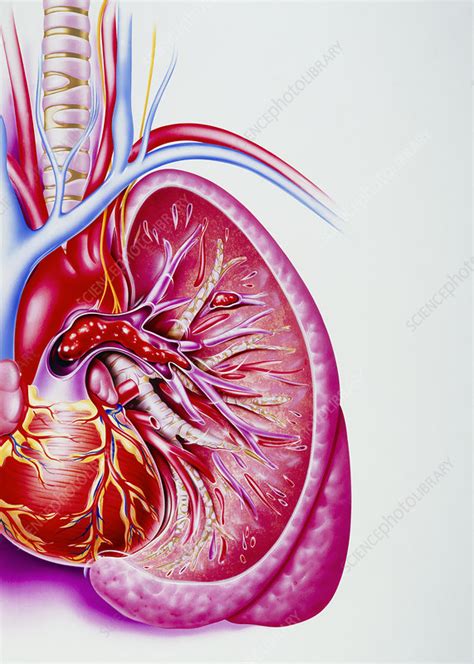 Artwork Showing A Pulmonary Embolism Stock Image M1750238