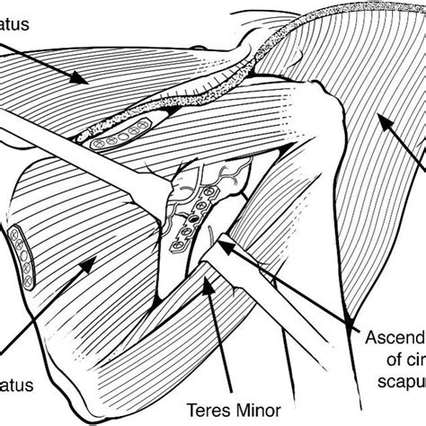 Infraspinatus And Teres Minor Interval Dissection And Fracture Exposure