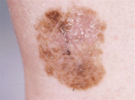 Superficial Spreading Melanoma On The Ankle Figure 1 Of 5