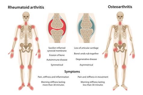 Osteoarhtritis Subhash Goyal