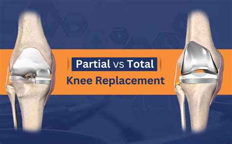 Partial Vs Total Knee Replacement Which Is Better Wellness Hospitals