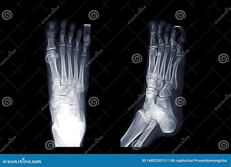 X Ray Right Foot Image Ap Oblique And Lateral Stock Image Image Of
