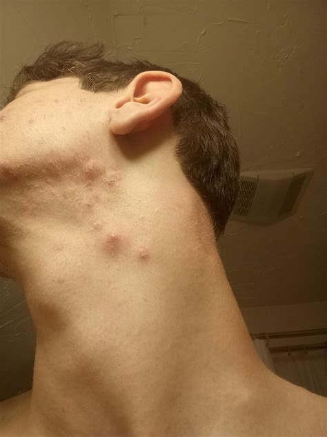Acne 18 Year Old Male And I Get Cystic Acne In The Same Spot Always