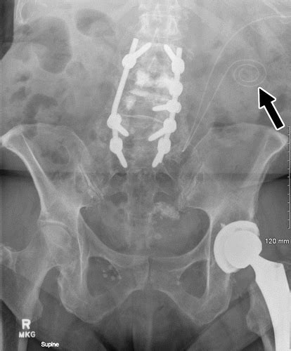 Interventional Radiology Placement And Management Of Tunneled