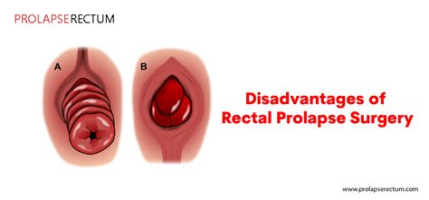 Disadvantages Of Rectal Prolapse Surgery