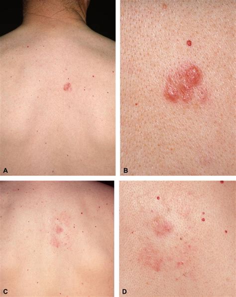 Clinicopathologic Features Of Early Lesions Of Primary Cutaneous