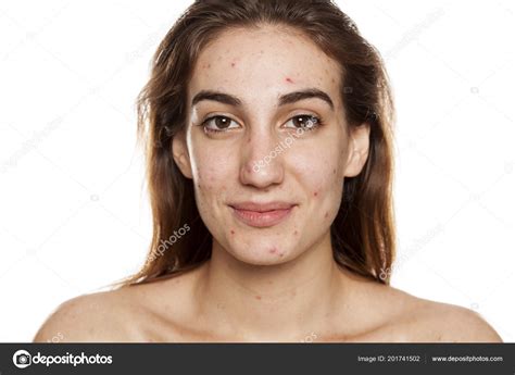 Young Smiling Woman Problematic Skin Makeup Posing White Background
