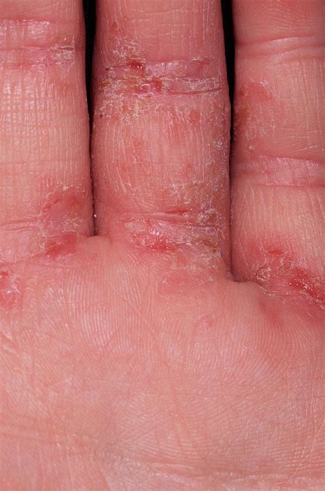 Eczema Photograph By Dr P Marazzi Science Photo Library