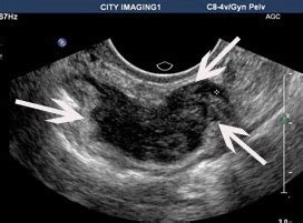 Endometriosis can affect women of any age. Can you diagnose Endometriosis via Ultrasound?