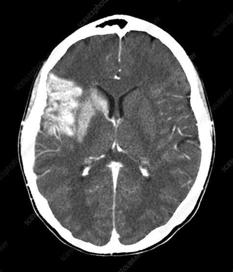 Stroke Ct Brain Scan Stock Image M1360288 Science Photo Library