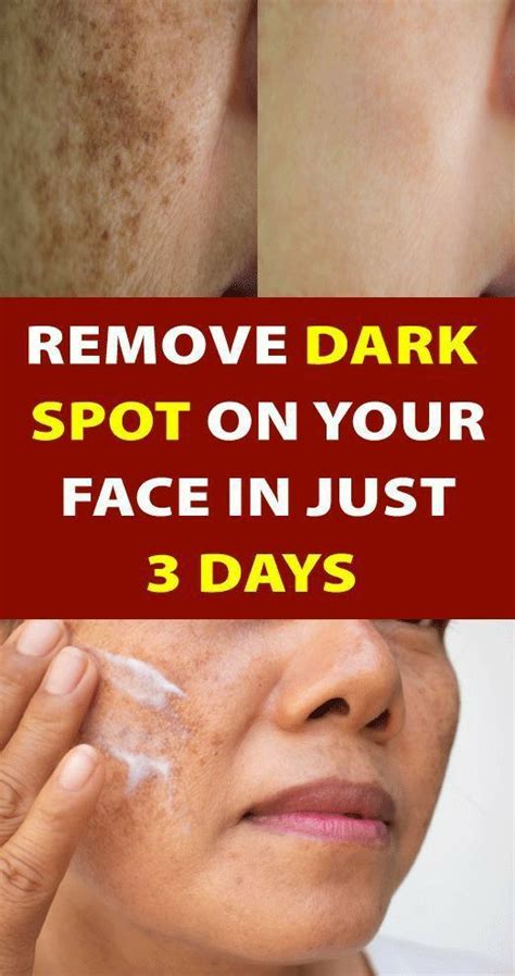 How To Remove Dark Spots On The Face Naturally Howotremvo