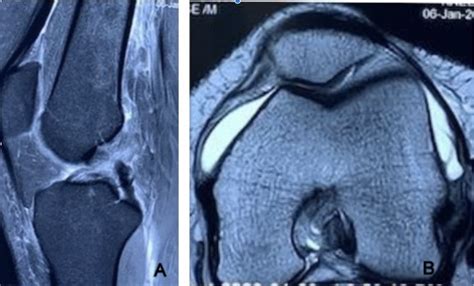 Cureus Concurrent Anterior Cruciate Ligament And Medial