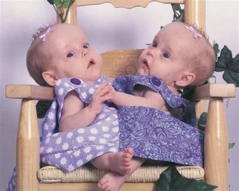 Kendra And Maliyah The Conjoined Herrin Twins Where Are They Now