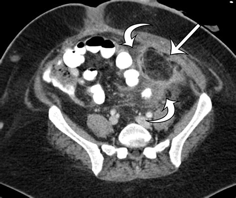 Soft Tissue Sarcomas Of The Abdomen And Pelvis Radiologic Pathologic