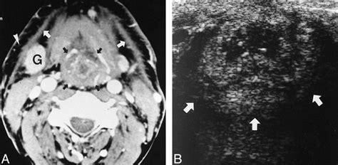 Fig 2 Sonographic Findings Of The Neopharynx After Total