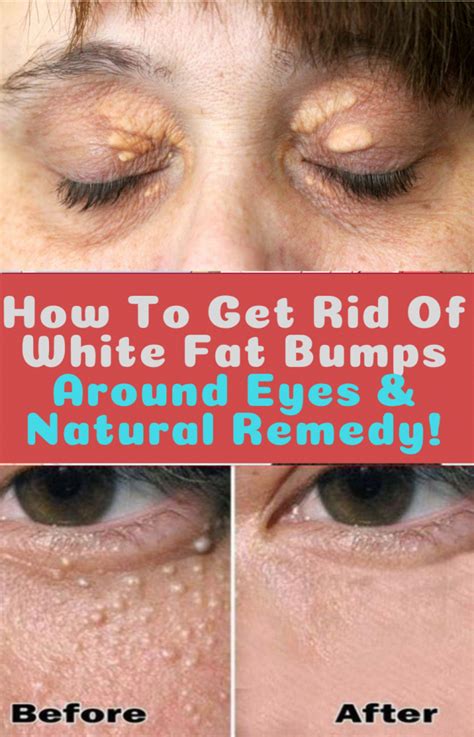 How To Get Rid Of White Fat Bumps Under Eyes In This Video I Will