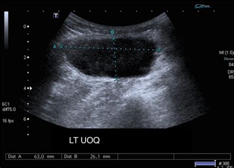 Post Iort Seroma Complication In Breast Cancer Surgery Journal Of