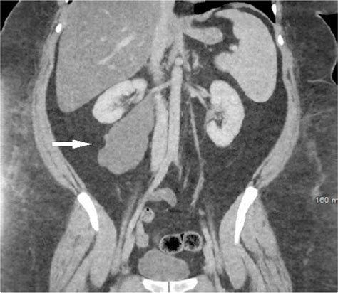 Ct Abdomen And Pelvis With Contrast Demonstrating A Multilobulated 79